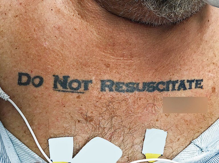 Life or Death: Patient with a ‘Do Not Resuscitate’ Tattoo. Doctors Demand Second Opinion.